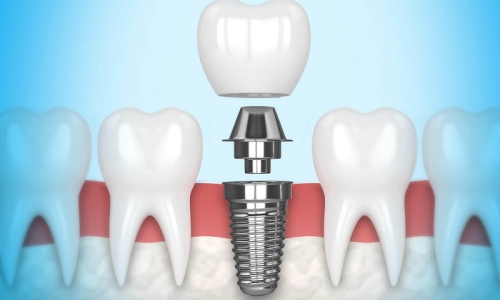 Mik a fogimplantátumok és hogyan működnek?